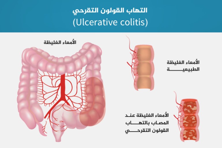 untit87444led-1-1 التهاب القولون التقرحي أمعاء قولون الأمعاء الغليظة (Ulcerative colitis)