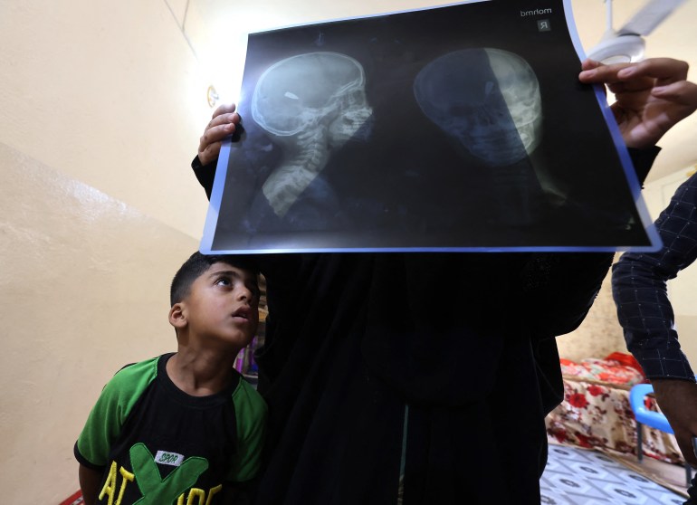 Muhammad Akram, 4-years-old, who was injured by a random gunshot in his home in a village in the Yusufiya not far from Baghdad on May 20, 2024, looks at his x-ray his home during a government campaign to register the weapons in possession of citizens. - Celebratory gunfire, clashes and armed feuds - sometimes over minor issues -- are a daily occurrence in Iraq, where firearm possession remains widespread despite a period of relative calm after decades of conflict. As of 2017, some 7.6 million firearms -- handguns, rifles and shotguns - were held by civilians in Iraq, according to Small Arms Survey, an organisation monitoring weapons around the globe. (Photo by AHMAD AL-RUBAYE / AFP)