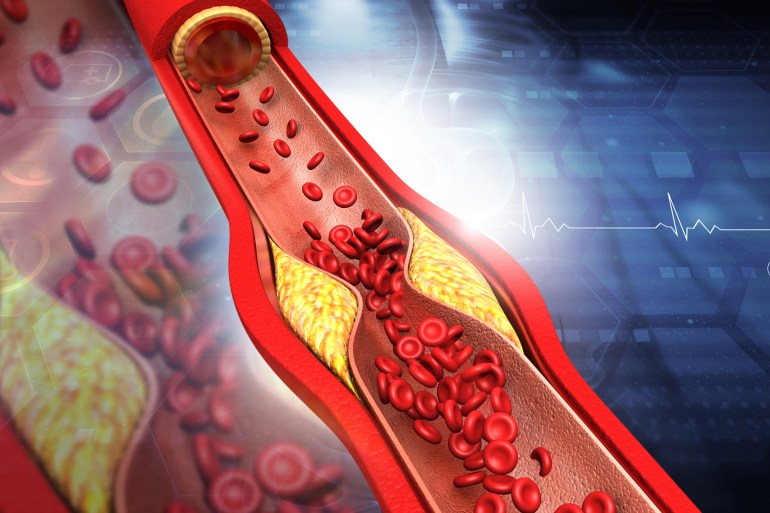 Clogged arteries, Cholesterol plaque in artery. 3d illustration كوليسترول الكوليسترول دهون شحم تصلب الشرايين صحة القلب