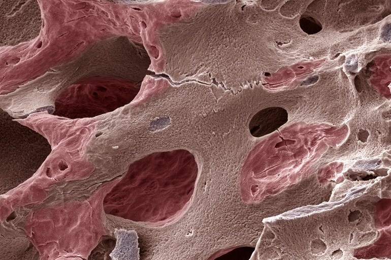 gettyimages-85757217-1723901642 Scanning electron micrograph (SEM) of human bone, osteoporosis - stock photo