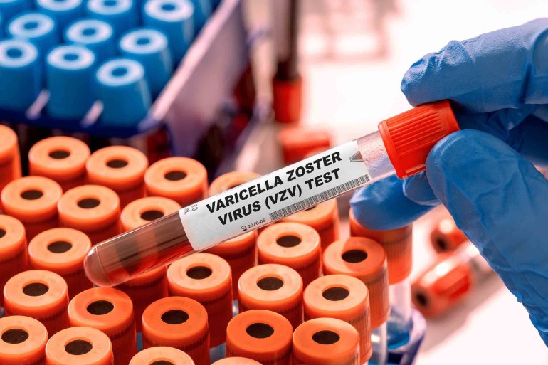 shutterstock_2176119615-1 يقلل التطعيم بلقاح جدري الماء من خطر الإصابة بالهربس النطاقي إلا أنه لا يمنع إعادة تنشيط العدوى (شترستوك)