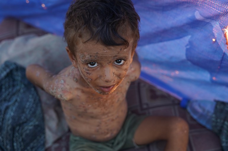 yt671-1725958460 نازحة فلسطينية داخل خيمتها وسط قطاع غزة تحاول إبعاد الذباب عن جسد طفلها فايز الذي يعاني من تقرحات جلدية وبثور كبيرة بسبب مرض جلدي تفاقم تأثيره في بيئة ملوثة سببتها الحرب الإسرائيلية على القطاع. ولا يكف فايز (4 سنوات) عن حك جسده المليء بالبثور والتقرحات التي تزداد اتساعا وانتشارا، بينما يعاني من مهاجمة الذباب دون أي حلول فعالة لتخفيف آلامه. ( İbrahim Nofal - وكالة الأناضول )