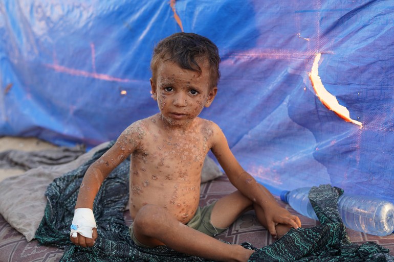 yt6719-1725958503 نازحة فلسطينية داخل خيمتها وسط قطاع غزة تحاول إبعاد الذباب عن جسد طفلها فايز الذي يعاني من تقرحات جلدية وبثور كبيرة بسبب مرض جلدي تفاقم تأثيره في بيئة ملوثة سببتها الحرب الإسرائيلية على القطاع. ولا يكف فايز (4 سنوات) عن حك جسده المليء بالبثور والتقرحات التي تزداد اتساعا وانتشارا، بينما يعاني من مهاجمة الذباب دون أي حلول فعالة لتخفيف آلامه. ( İbrahim Nofal - وكالة الأناضول )