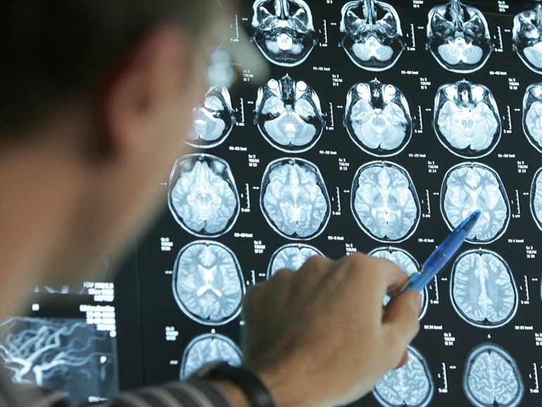 51e6c392-2d75-4f09-bf5d-88121234a8af أعراض السكتة الدماغية تتمثل في الصداع الشديد المفاجئ والشلل المفاجئ على أحد جانبي الجسم واختلالات الإحساس وتدلي زاوية الفم واضطرابات الرؤية والكلام والدوار وعدم الاتزان أثناء المشي. (النشر مجاني لعملاء وكالة الأنباء الألمانية “dpa”. لا يجوز استخدام الصورة إلا مع النص المذكور وبشرط الإشارة إلى مصدرها.) عدسة: dpa صور: Friso Gentsch/dpa