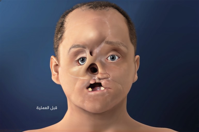 d98ad984d8b3d98ad8a8d984d8b31-1732615811 صورة رجل قبل إجراء عملية زراعة الوجه حسب ما ظهر في فيديو عرضه لمايو كلينك