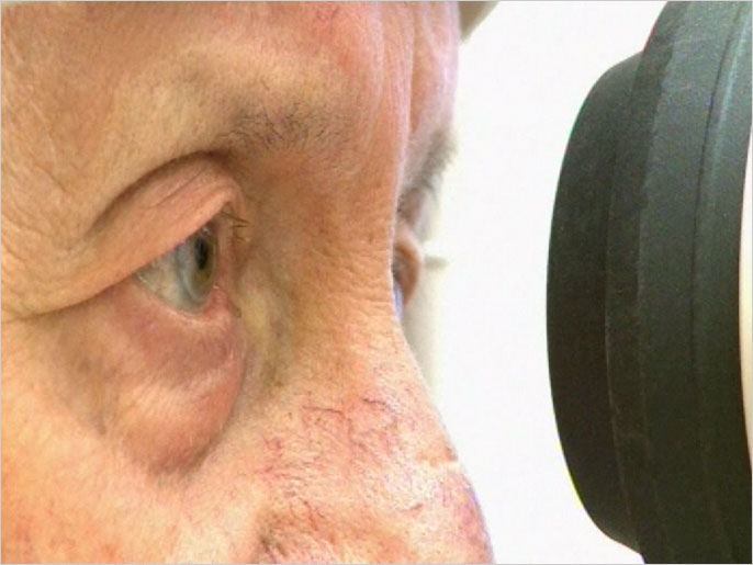 تفاؤل بتحسين نظر المصابين بمرض التنكس البقعي