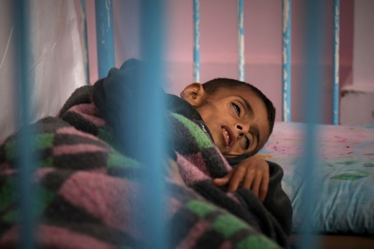 ap_6818755f7d89b-1746433375 Osama al-Raqab, 5, whose mother says his cystic fibrosis has worsened since the start of the war due to the lack of meat, fish and enzyme tablets to help him digest food, is being treated at the malnutrition clinic in Nasser hospital, Khan Younis, Gaza, on Thursday, May 1, 2025. (AP Photo/Abdel Kareem Hana)
