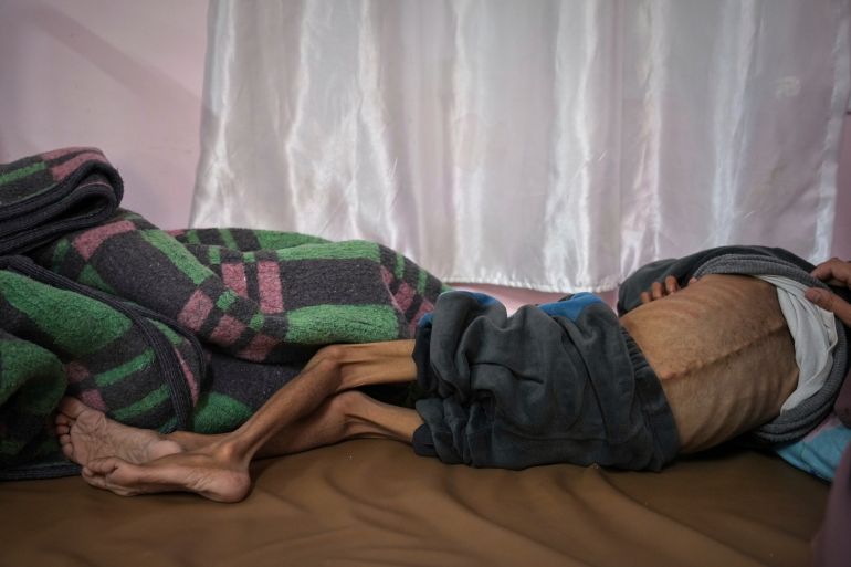 ap_6818c307ae941-1746453255 Mona al-Raqab lifts the shirt of her 5-year-old son, Osama al-Raqab, revealing signs of malnutrition and worsening cystic fibrosis, exacerbated since the start of the war by the shortage of meat, fish, and enzyme tablets needed to help him digest food, as he receives treatment at the malnutrition clinic in Nasser hospital, Khan Younis, Gaza Strip, Thursday, May 1, 2025(AP Photo/Abdel Kareem Hana)
