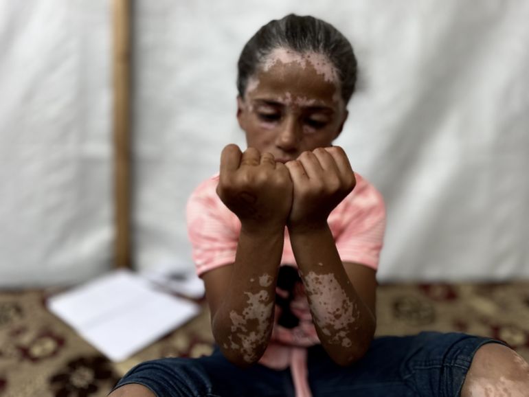 d984d8a7d986d8a7-d8b7d981d984d8a9-d981d984d8b3d8b7d98ad986d98ad8a92-1747145332 داخل خيمة مهترئة على أطراف أحد مخيمات النزوح بمدينة خان يونس جنوبي قطاع غزة، تجلس الطفلة الفلسطينية لانا الشريف متشبثة بما تبقى من طفولتها بعد 19 شهرا من حرب الإبادة الجماعية التي ترتكبها إسرائيل عاشت خلالها صدمات قاسية وأفقدتها معظم حقوقها. فلم ينجح القميص الوردي الذي ترتديه الشريف وطبع عليه شخصية "ميكي ماوس" الكرتونية في إضفاء قليل من الفرحة على ملامحها التي بدت مثقلة بالحزن بعدما وُشم جسدها بندوب بيضاء أشبه بمرض "البهاق" وفق تقدير أطباء بغزة. وعبر مرآة صغيرة، تتأمل الطفلة الشريف شكلها الذي غيرته حرب الإبادة الإسرائيلية المتواصلة إذ غزا شعرها "الشيب الأبيض" وهي لم تتجاوز سنواتها العشر بسبب تعرضها للخوف الشديد. ( Doaa Albaz - وكالة الأناضول )