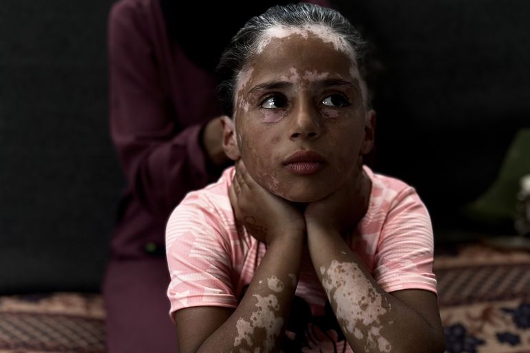 d984d8a7d986d8a7-d8b7d981d984d8a9-d981d984d8b3d8b7d98ad986d98ad8a93-1747145325 داخل خيمة مهترئة على أطراف أحد مخيمات النزوح بمدينة خان يونس جنوبي قطاع غزة، تجلس الطفلة الفلسطينية لانا الشريف متشبثة بما تبقى من طفولتها بعد 19 شهرا من حرب الإبادة الجماعية التي ترتكبها إسرائيل عاشت خلالها صدمات قاسية وأفقدتها معظم حقوقها. فلم ينجح القميص الوردي الذي ترتديه الشريف وطبع عليه شخصية "ميكي ماوس" الكرتونية في إضفاء قليل من الفرحة على ملامحها التي بدت مثقلة بالحزن بعدما وُشم جسدها بندوب بيضاء أشبه بمرض "البهاق" وفق تقدير أطباء بغزة. وعبر مرآة صغيرة، تتأمل الطفلة الشريف شكلها الذي غيرته حرب الإبادة الإسرائيلية المتواصلة إذ غزا شعرها "الشيب الأبيض" وهي لم تتجاوز سنواتها العشر بسبب تعرضها للخوف الشديد. ( Doaa Albaz - وكالة الأناضول )