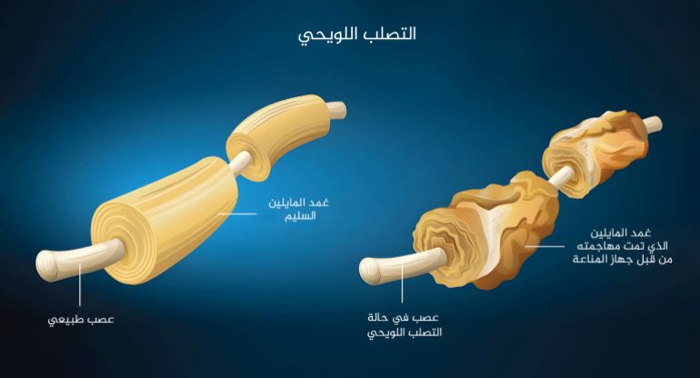 4545454-1685457667 ***داخليه**** Illustration showing the multiple sclerosis إنفوغراف التصلب اللويحي Multiple sclerosis MS ويعرف أيضا باسم التصلب المتعدد التصلب العصبي المتعدد