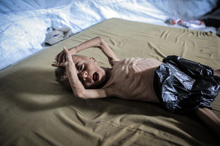 asdasdas3-1753177749 GAZA CITY, GAZA - JULY 21: Muhammad Zakariya Ayyoub al-Matouq, a 1.5-year-old child in Gaza City, Gaza, faces life-threatening malnutrition as the humanitarian situation worsens due to ongoing Israeli attacks and blockade, on July 21, 2025. Having dropped from 9 to 6 kilograms, he struggles to survive in a tent in Gaza City, where milk, food, and other basic necessities are lacking. ( Ahmed Jihad Ibrahim Al-arini - Anadolu Agency )