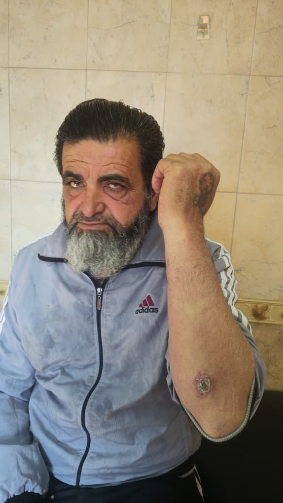 d985d988d8b3d989-1765204388 يستعرض موسى الموسى (52 عاما)، القادم من ريف حلب الغربي، آثار الإصابة بالليشمانيا بمناطق عدة من جسده المنهك (الجزيرة)
