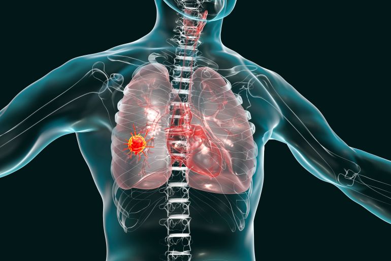 Lung cancer, computer illustration showing malignant tumour in the lung.
