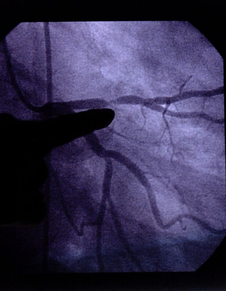 Dr. John Lasala, an associate professor of medicine at St. Louis' Washington University and a Barnes-Jewish Hospital heart specialist, points to an image of a coronary artery with 80 to 90 percent blockage from another patient, Monday, June 24, 2002, in St. Louis. St. Louis Cardinals pitcher Darryl Kile's preliminary autopsy report showed two of the three branches of the coronary artery with comparable blockage. (AP Photo/Tom Gannam)