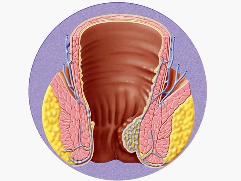 نزف من البواسير