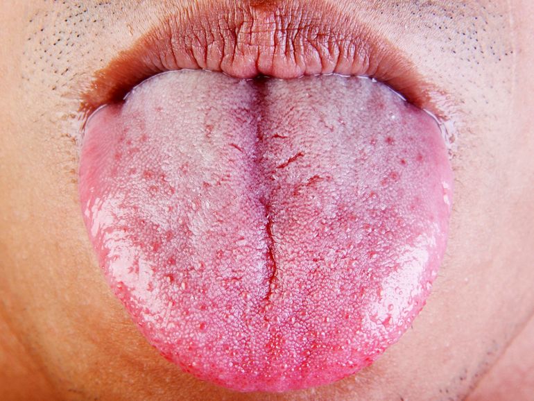 تعتبر حالة اللسان مؤشرا على حالة الجهاز الهضمي الصحية. (النشر مجاني لعملاء وكالة الأنباء الألمانية “dpa”. لا يجوز استخدام الصورة إلا مع النص المذكور وبشرط الإشارة إلى مصدرها.) عدسة: dpa صور: Erich Braunsperger/dpa