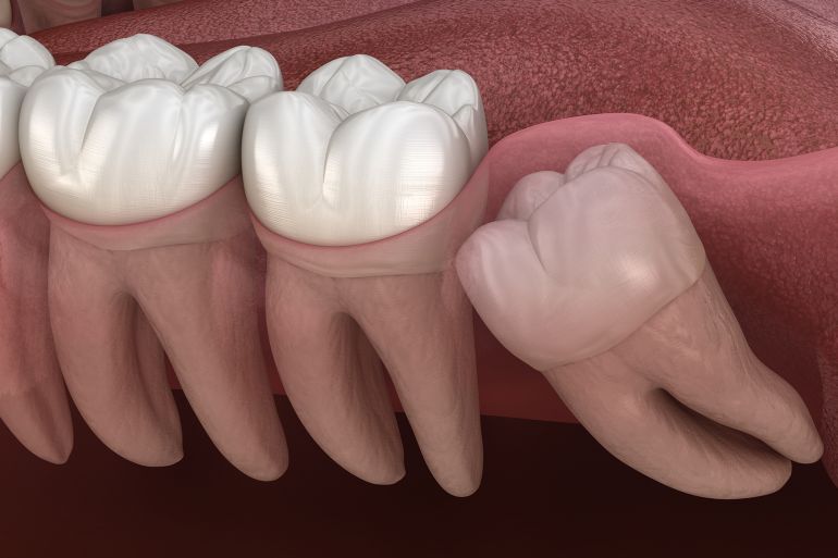 Wisdom tooth with impaction at molar tooth. Medically accurate tooth 3D illustration