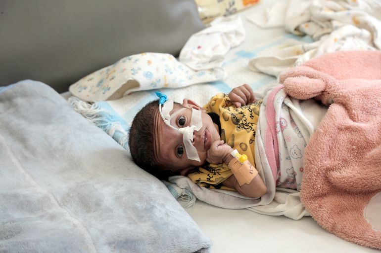 SANA'A, YEMEN - DECEMBER 14: A child suffering from malnutrition obtains treatment at a health facility on December 14, 2024, in Sana'a, Yemen. By the end of the year 2024, Yemen has been marked to be one of the most vulnerable nations on the planet with the highest malnutrition rates, where around 5 million children under five were left in urgent need of life-saving nutrition healthcare. (Photo by Mohammed Hamoud/Getty Images)