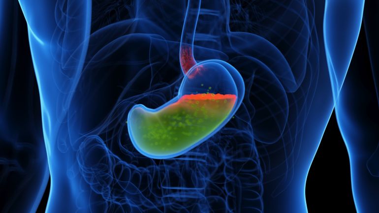 Gastroesophageal reflux disease, illustration