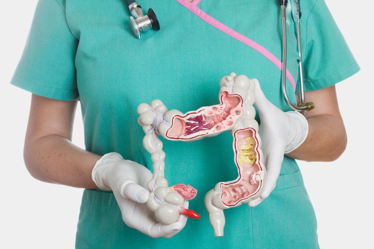 Female nurse holding anatomical model of human colon with pathologies. The model shows appendicitis, cancer, Crohn’s disease, spastic colon, ulcerative colitis, polyps, diverticulosis, diverticulitis, bacterial infection and adhesions. الزائدة الدودية أمعاء الأمعاء قولون القولون