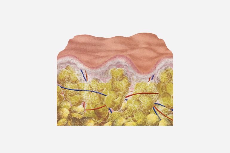 gettyimages-2141075629-1715767794 Section of skin with cellulite (compared to smooth skin) with epidermis, dermis and hypodermis, collagen fiber, adipocyte (fat cells) and blood vessels. (Photo by: SALIEGES/BSIP/Universal Images Group via Getty Images)