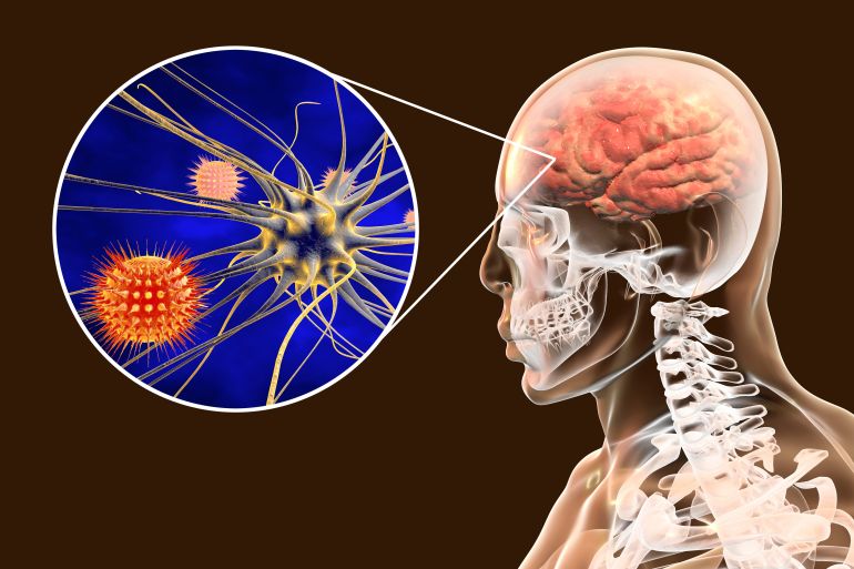 shutterstock_1098015326-1741769982 Viral meningitis and encephalitis, medical concept, 3D illustration showing brain infection and close-up view of viruses in the brain