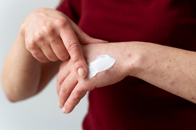 Skin allergy on a person's arm المصدر فري بيك