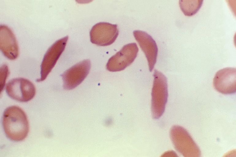 ap_6a4649fc0c2eb-1782991356 FILE - This microscope photo provided on Oct. 25, 2023, by the Centers for Disease Control and Prevention shows crescent-shaped red blood cells from a sickle cell disease patient in 1972. Britain's medicines regulator has authorized the world's first gene therapy treatment for sickle cell disease, in a move that could offer relief to thousands of people with the crippling disease in the U.K. In a statement on Thursday, Nov. 16, 2023, the Medicines and Healthcare Regulatory Agency said it approved Casgevy, the first medicine licensed using the gene editing tool CRISPR, which won its makers a Nobel prize in 2020. (Dr. F. Gilbert/CDC via AP, File )