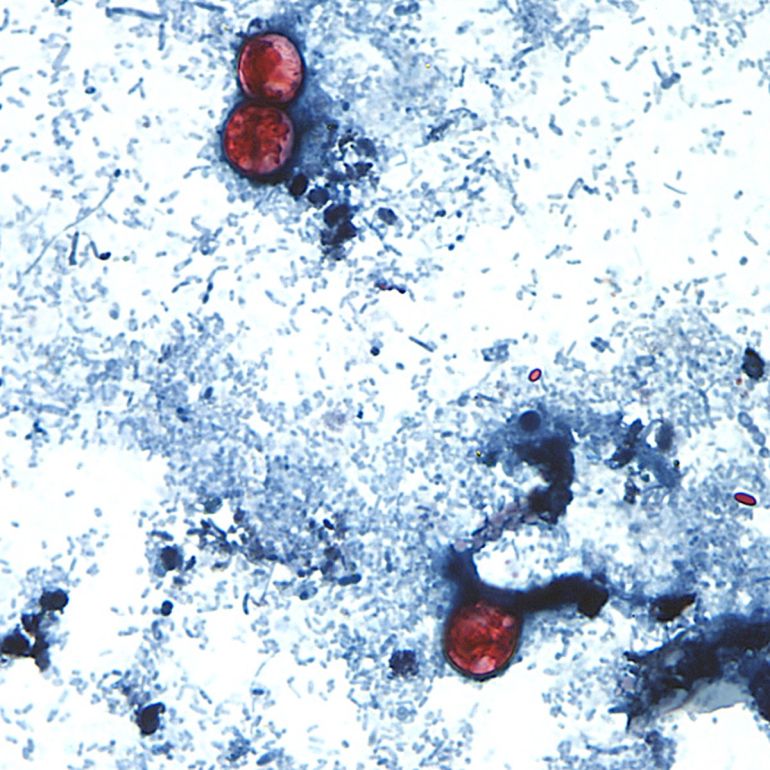 This undated photo taken through a microscope provided by the CDC shows Cyclospora cayetanensis oocysts found in a fresh stool sample which had been prepared with a formalin solution and stained with safranin. (CDC via AP)