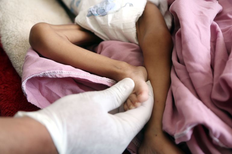 09887-1786708557 SANAA, YEMEN - JULY 22: Children suffering from severe acute malnutrition continue to receive treatment under limited medical conditions at Al-Sabeen Hospital in Sanaa, Yemen, on July 22, 2026. The children are being treated in the hospital's neonatal intensive care unit (NICU) for premature infants and malnutrition ward. Located in the Yemeni capital controlled by the Iran-backed Houthis, the hospital continues to provide care despite limited resources. (Photo by Mohammed Hamoud/Anadolu via Getty Images)
