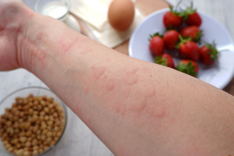 Close up image of arm suffering severe urticaria or hives or kaligata with illustration of allergy trigger foods. Eggs, milk, beans, strawberry, and ... See More by wisely @ادوبي ستوك