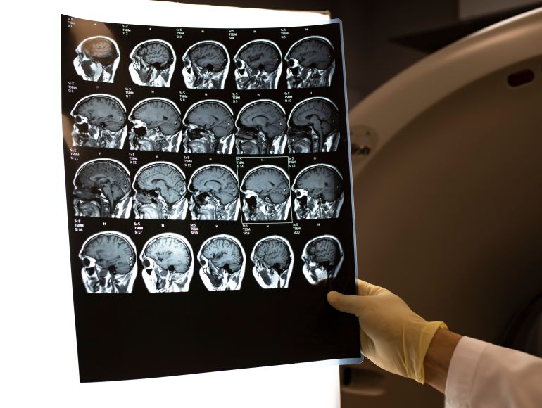 gettyimages-1226268929-1786047662 MRI scan of the brain. The doctor looks at the picture in the office. Magnetic resonance scan of the brain.