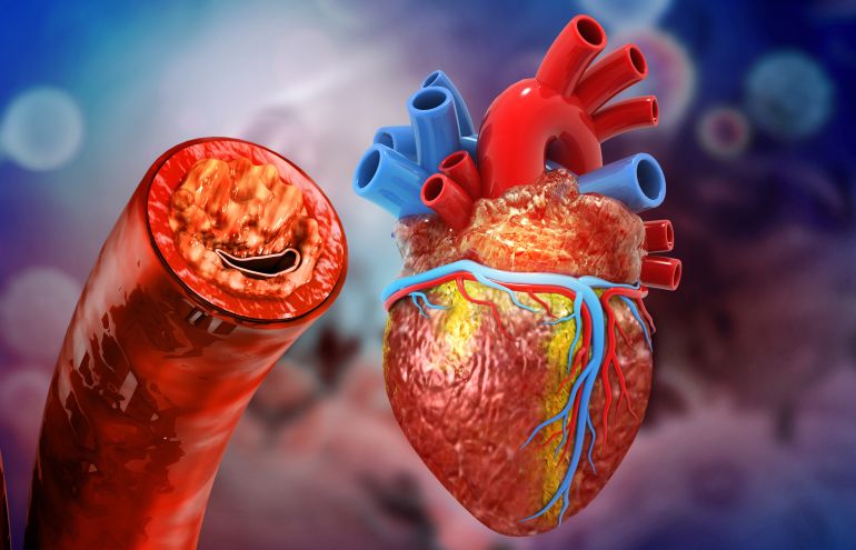 gettyimages-1272367573 Human heart anatomy and clogged arteries. 3d illustration الكوليسترول