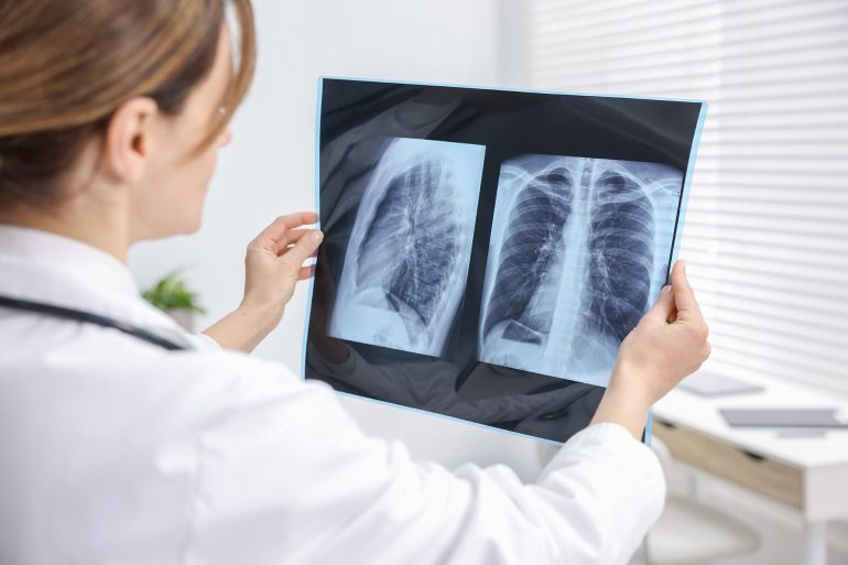 shutterstock_2609918125-1772892109 Doctor examining lungs x-ray in hospital, closeup; Shutterstock ID 2609918125; purchase_order: aj; job: ; client: ; other: