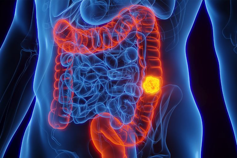 12-1789719272 3D rendered Medical Illustration of Male Anatomy - Colon Cancer; Descending Colon. المصدر AdobeStock