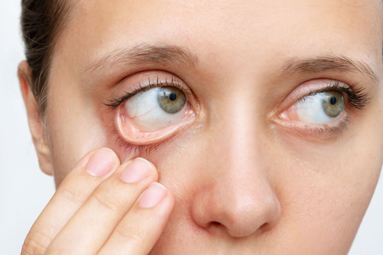 67878-1789723425 Cropped shot of a young caucasian woman showing off her pale conjunctiva isolated on a white background. Iron deficiency anemia. Reduced hemoglobin by Марина Демешко @ادوبي ستوك