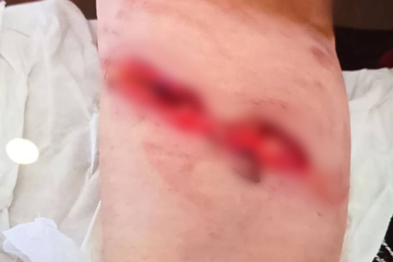 ****داخلية**** إصابة تعرضت لها سيدة نتيجة هجوم كلب بوليسي خلال مداهمة دورية اسرائيلية لمنزلها سوريا الأن