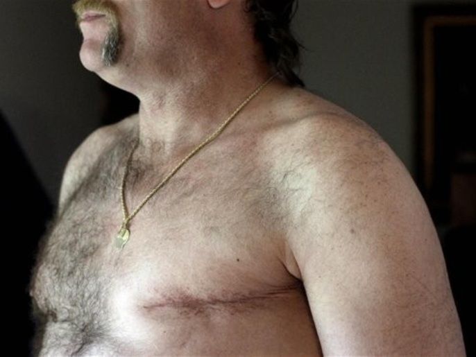 ea15b868-1def-47cc-953e-31d3b5f4ee37 In this May 3, 2012 photo, a surgery scar is seen on breast cancer survivor Robert Kaitz's left breast in his home in Severna Park, Md. Kaitz thought a small growth under his left nipple was just a harmless cyst. By the time he had it checked out in 2006, almost two years later, the lump had started to hurt. The diagnosis was a shock. "I had no idea in the world that men could even get breast cancer," Kaitz said. Now Kaitz does frequent self-exams and has mammograms every year. The American Cancer Society estimates 1 in 1,000 men will get breast cancer, versus 1 in 8 women.